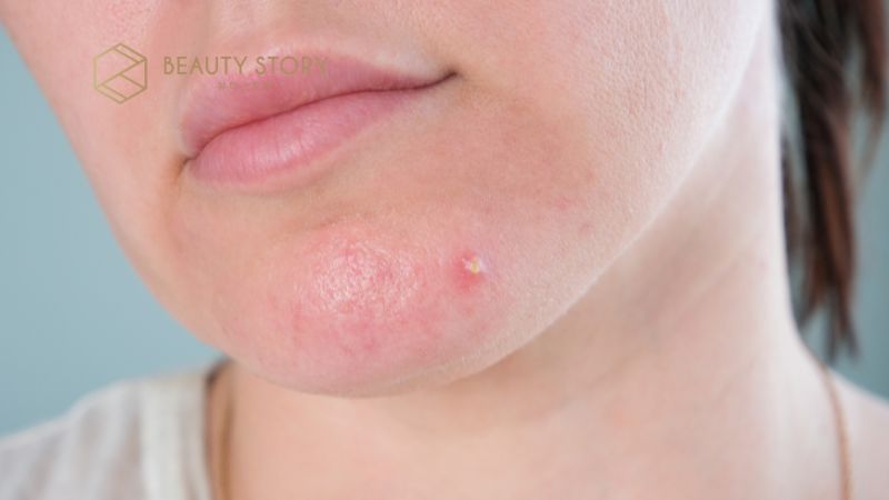 Mụn bọc không đầu xử lý thế nào để không để lại sẹo thâm?