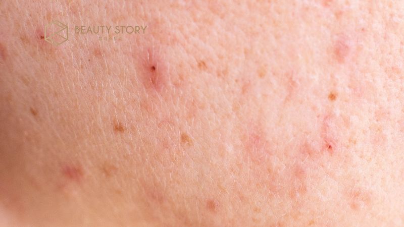 Mụn ẩn có tự hết không? Chuyên gia da liễu giải đáp thắc mắc.