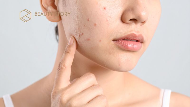 Top 7 nguyên nhân gây mụn trứng cá phổ biến nhất và cách khắc phục