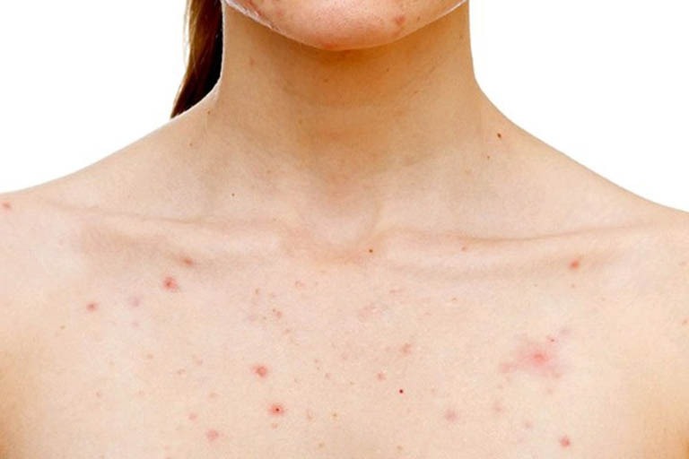 Viêm Nang Lông Và Cách Điều Trị